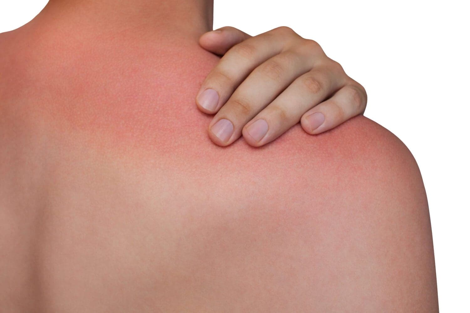 A hand resting on a bare shoulder and upper back marked by red, inflamed sunburn against a white background.